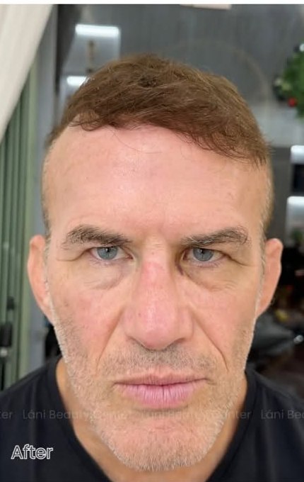 Wrinkles / Botox
