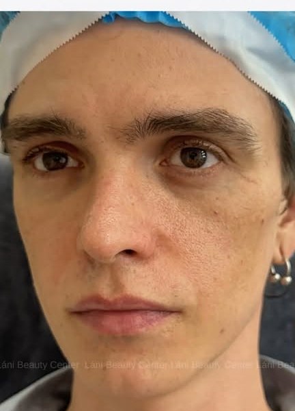 Tạo hình gò má & midface Trước
