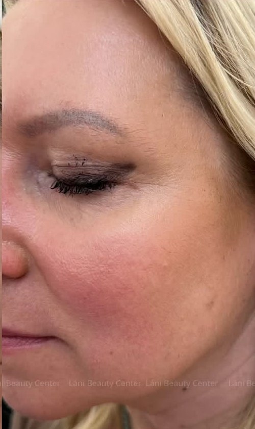 Mesotherapy